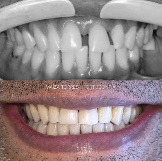 Antes e depois — Dra. Maíza Torres