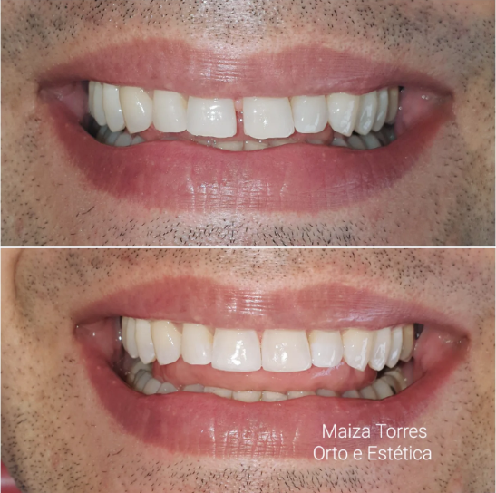 Antes e depois — Dra. Maíza Torres