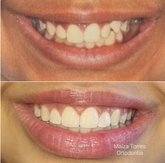 Antes e depois — Dra. Maíza Torres